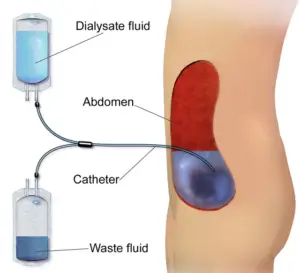 peritoneal dialysis nurses